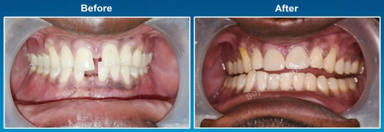 Before and After Image Dental Implants Case